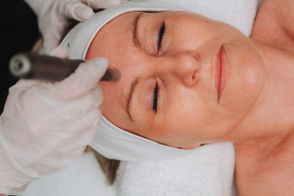 Schoonheidsspecialiste voert Microneedling uit op het voorhoofd van een cliënte