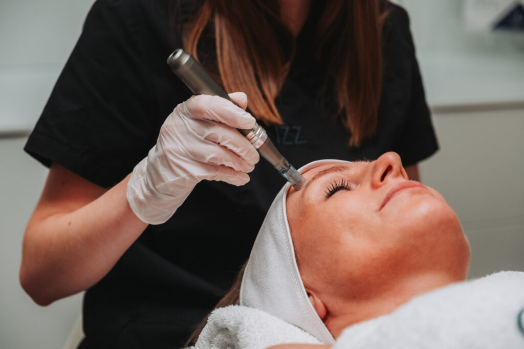 Schoonheidsspecialiste voert Microneedling uit op het voorhoofd van een cliënte