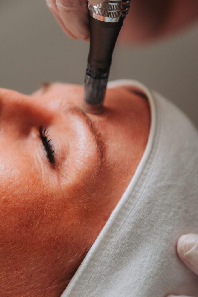 Schoonheidsspecialiste voert Microneedling uit op het voorhoofd van een cliënte